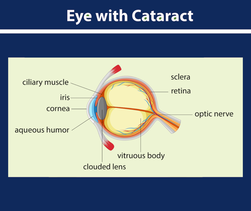 staten island cataract surgery