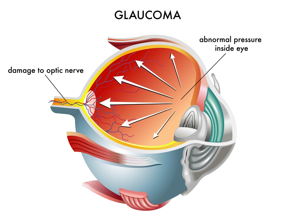 staten island glaucoma